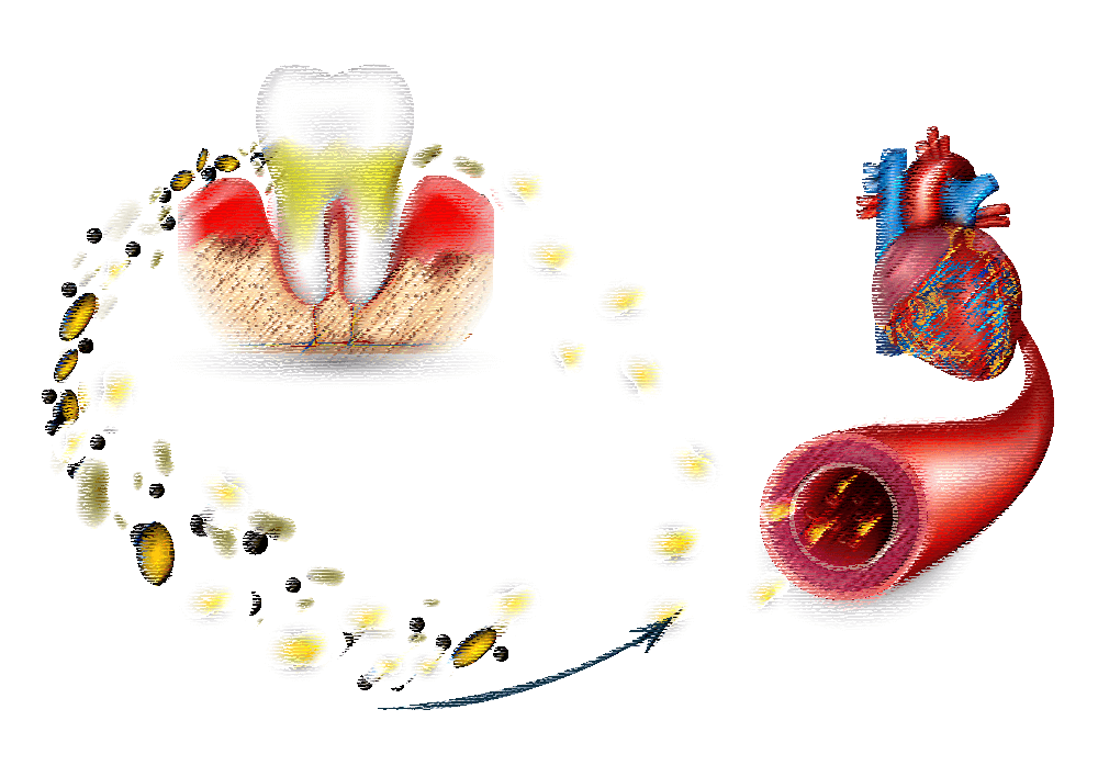 歯周病と心疾患（心臓）