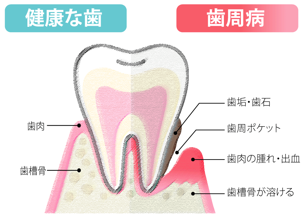 歯周病