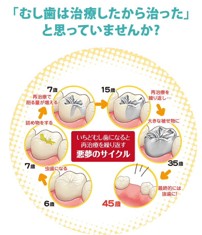 フッ素で虫歯予防