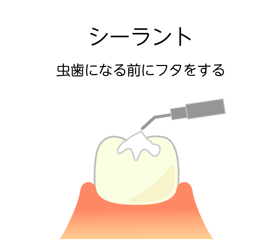 シーラントは6歳臼歯がはえてから